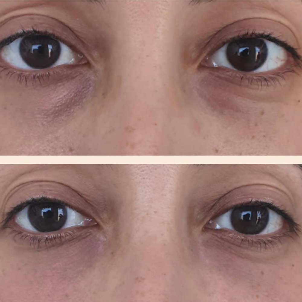 medicina estética málaga corrección de ojeras