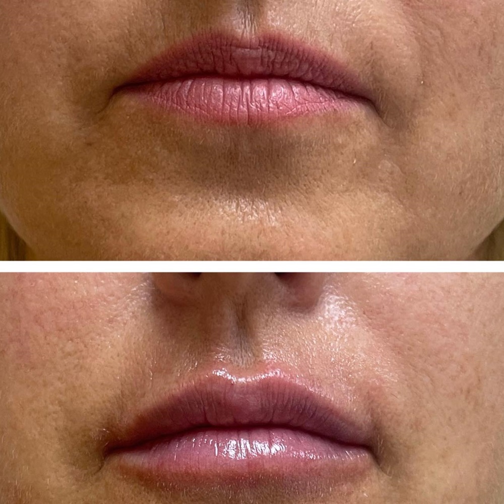 medicina estética málaga relleno de labios