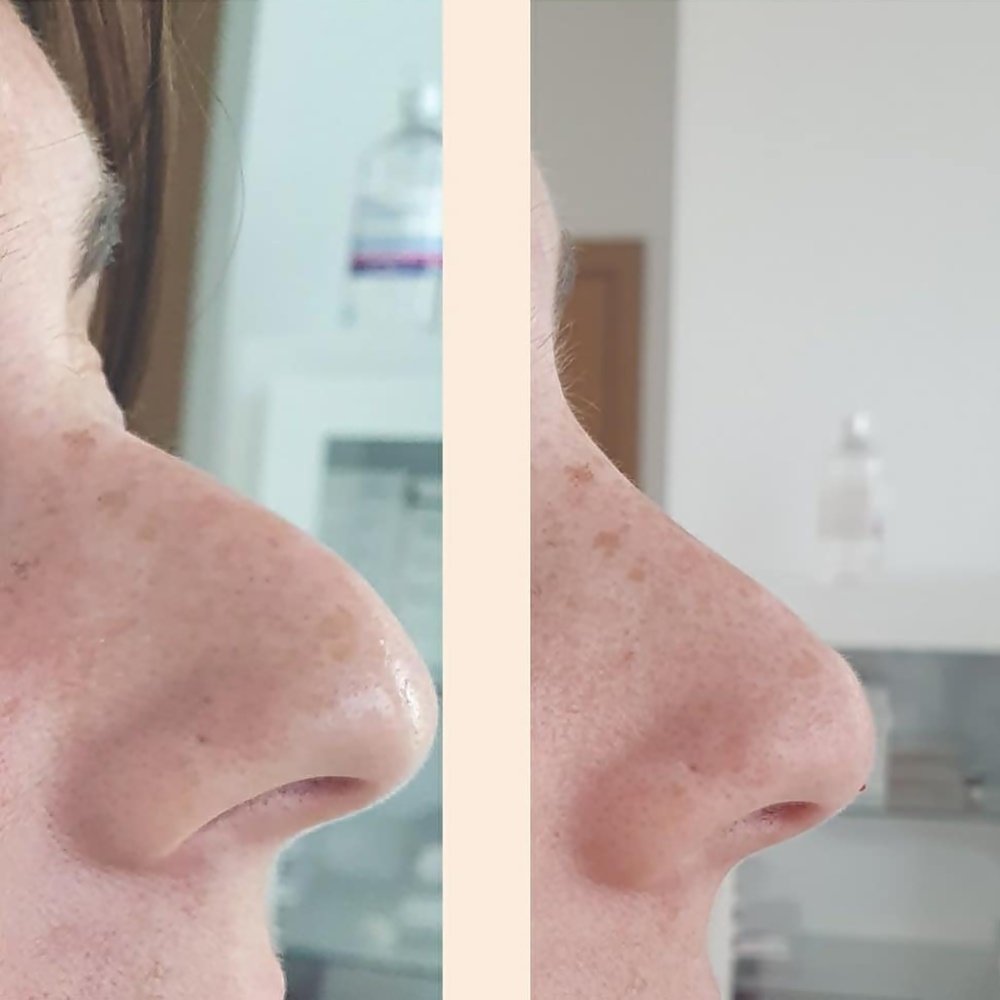 medicina estética málaga rinoremodelación