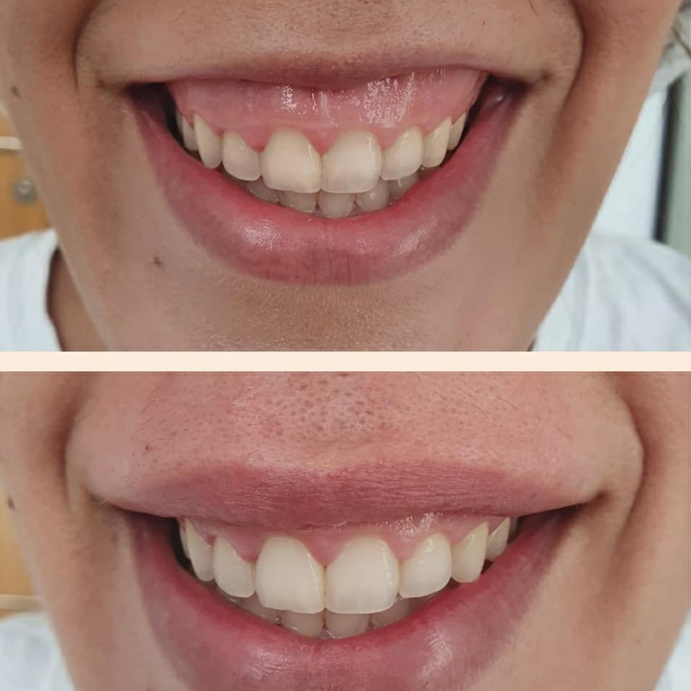 medicina estética málaga sonrisa gingival