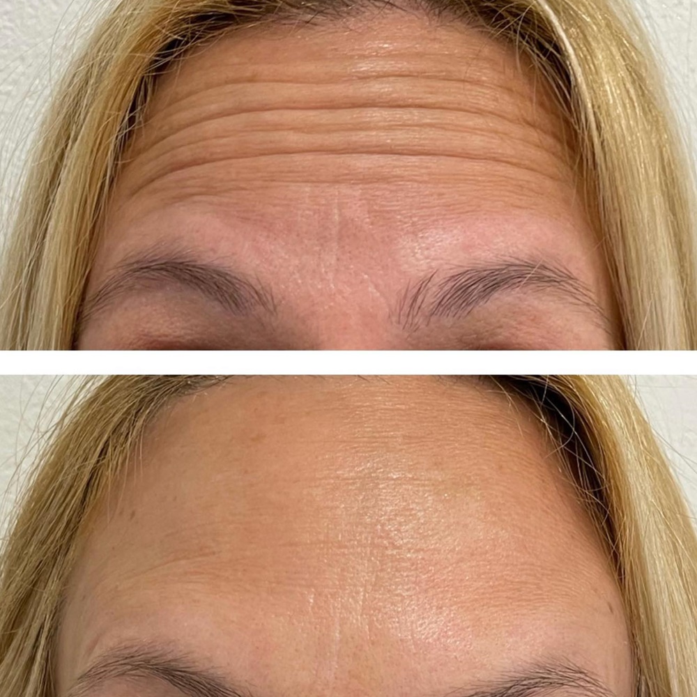 medicina estética málaga toxina botulímica