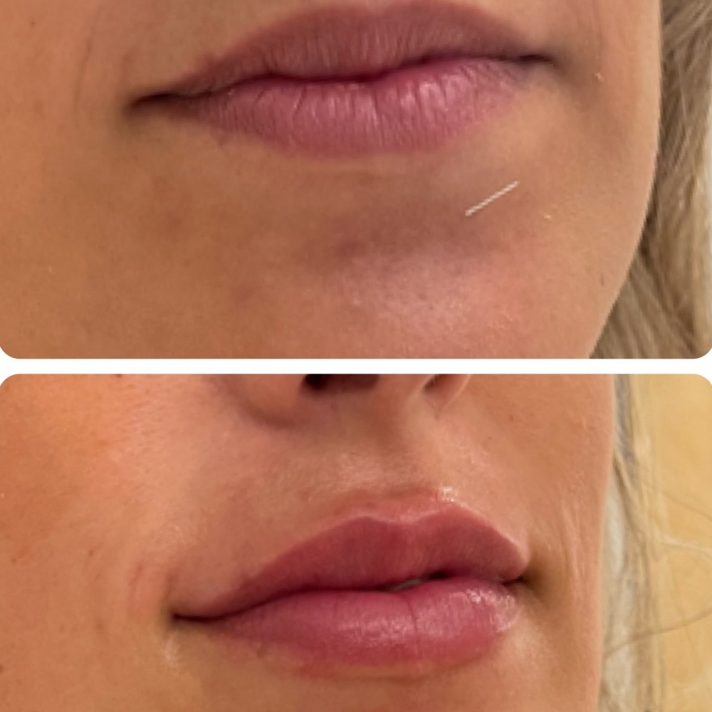 relleno de labios ácido hialurónico