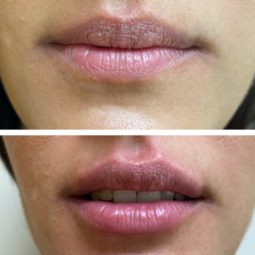 relleno de labios ácido hialurónico