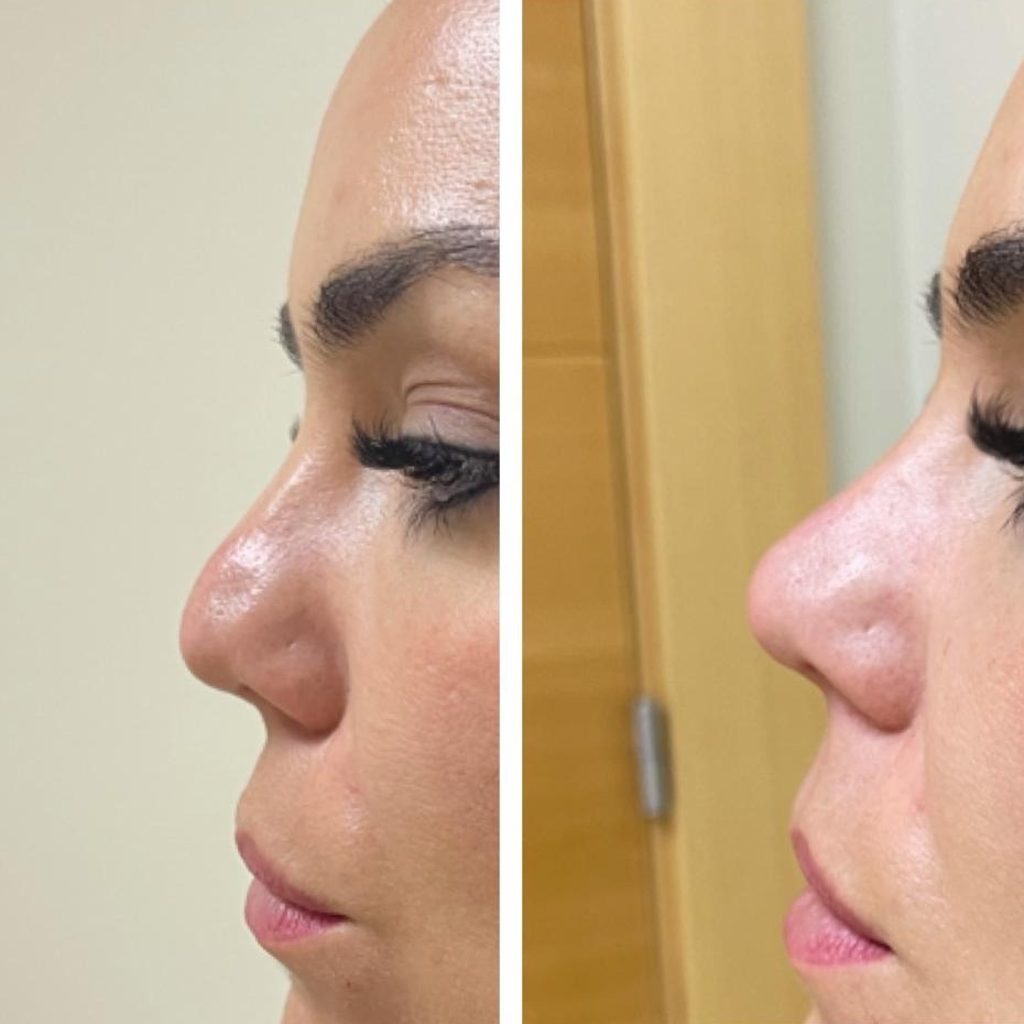 medicina estética málaga rinoremodelación